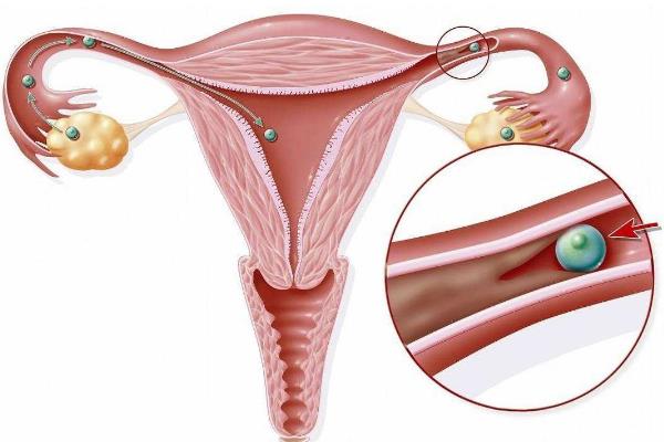 输卵管内的液体会影响怀孕吗？在决定做试管婴儿治疗之前，我是否应该先治疗它？